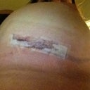 Left side incision