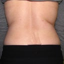 2mos post op