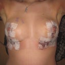 finally took off the gauze