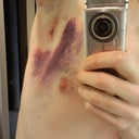 A lot of internal bleeding, but not painful at all.  Very little redness or swelling after two days.