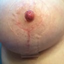 Right scar week 8 with clear scar strip on