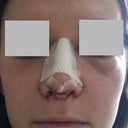 Day 2 after surgery (a.m.)