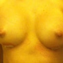 boobies are starting to even out. Post op day 6