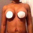 1/14/13 don't laugh made my gauze circular shape.. Breast still a lil firm and swollen