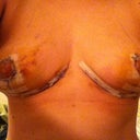 4 days post op