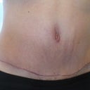 Scar is barely quilted any more at 6 weeks po today.  Belly button is better.