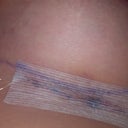 Incision under my breast