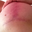 the widest part of the scar...right at the bottom of the breast where the t meets