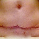 9 weeks out from Sx.  Scar is healing nicely.  I'm using vitamin E and massaging the scar at least once a day.