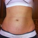 Pre-op Front View