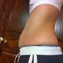 Pre-op Side View
