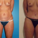 19 days post surgery