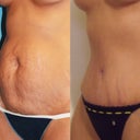 19 days post surgery