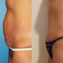 19 days post surgery