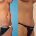 19 days post surgery