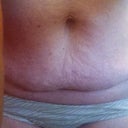 my flap and hernia