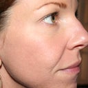 Day 5 after Fraxel #3.