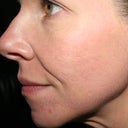 Day 5 after Fraxel #3.