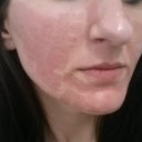 Still red and blotchy but worth it