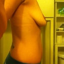 Pre Op Right Side View