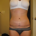 Incision front