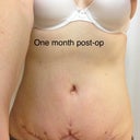 The "divot" above my scar line is from a belly button ring scar that couldn't be removed (due to immense scar tissue around it) but will be removed in 6 months under local anesthesia when I'm healed.