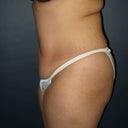 this is me the morning of surgery in June 2012