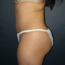 this is me 6 months later. He took this pic 2 days ago when I saw him for my regular follow up.