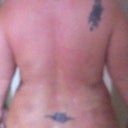 Bra roll day after surgery