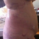 Very bruised and swollen, I was told the skin sagging will slowly get tighter over the next few weeks. But am happy so far with results