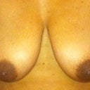 These are my preoperative pics, I will add intra and post op pics when they become availiable.