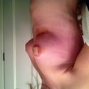 Day one post-op