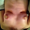 Day one post-op