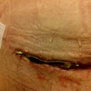 5 Week post op and incision issues