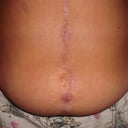 This is my scarred stomach from having too many operations the pictures dont make the scarring look too bad! but trust me they are!