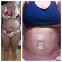 before and 3 days after surgery