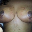 the right breast is still very swollen