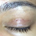 Eyelid closed, incision is visible.