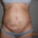 17 days post op - heres an incision pic. The bruising is slowly subsiding. Still quite swollen