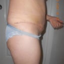 17 days post op right side on