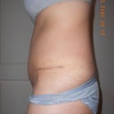 17 days post op left side on