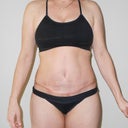 4 weeks post op  - incision pic