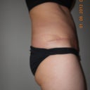 4 week post op