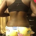 7 days post op back view