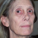 Before - Wrinkes, Sun Damage, NO fat Skelton Face!