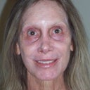 Yikes SunScreen on face looks ghost like, Flash makes eyes look red! Under eyes PINK 1 month not red, Skin Beautiful, Fat Fill wonderful!