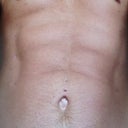 6 weeks post op and went in to see Dr. Lanzer today for a check up. He seemed very pleased with the results, as am I. He recommended 'spectra gel' for my scars which is a very sticky substance that will hopefully help those little round scars heal quickly.