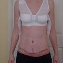 2 weeks after surgery - front. Cute belly button, huh?