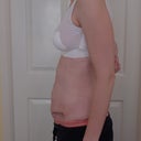 2 weeks after surgery - side.  Bad posture still, but the pooch is still in evidence