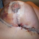 Post op day 3--lefty